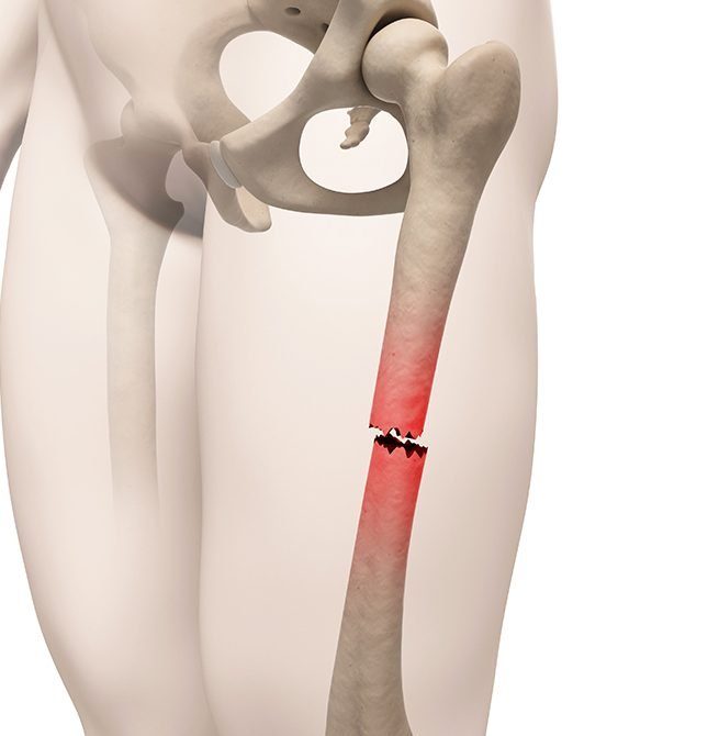 Complex Fracture &amp; Trauma